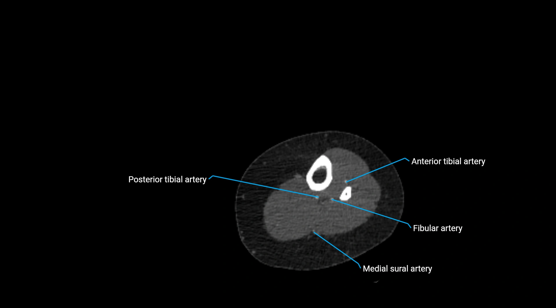 CTA lower limb cross sectional anatomy labelled image _209.webp